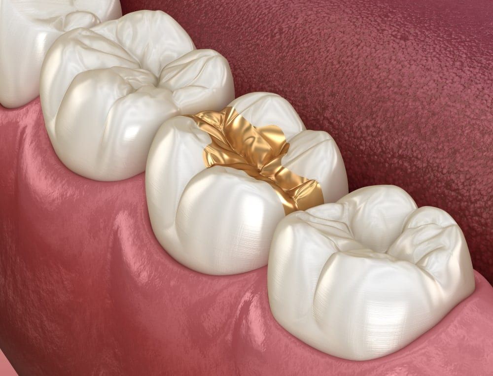 dental inlay made of gold
